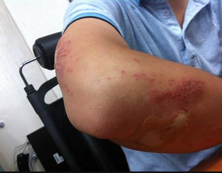 When Should I Hire A Workers’ Comp Lawyer?